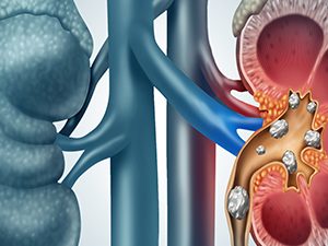 Μιξ Νεφρολιθίασης 120γρ